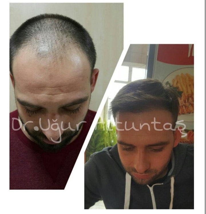 Trapianto di capelli in Turchia prima e dopo