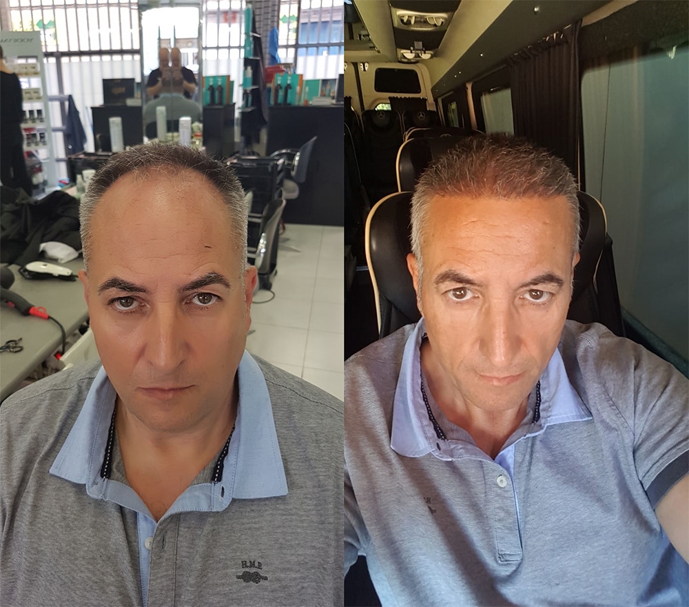 prima e dopo l'innesto di capelli