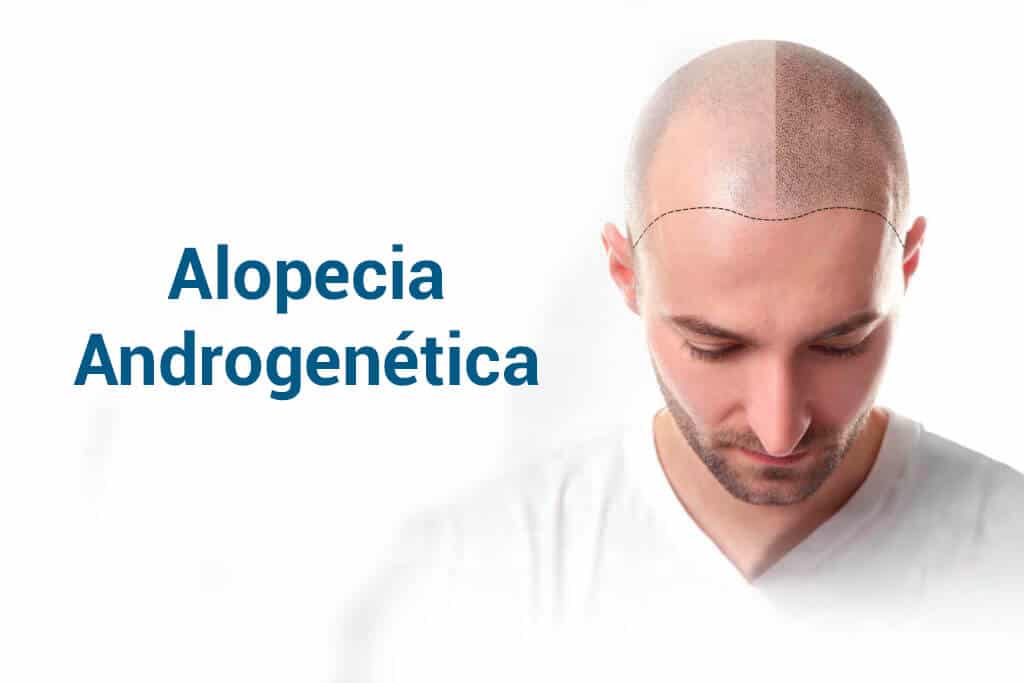 Alopecia androgenetica