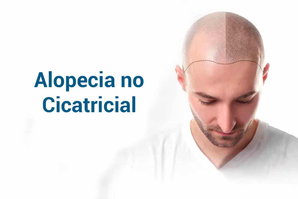 Alopecia non cicatriziale