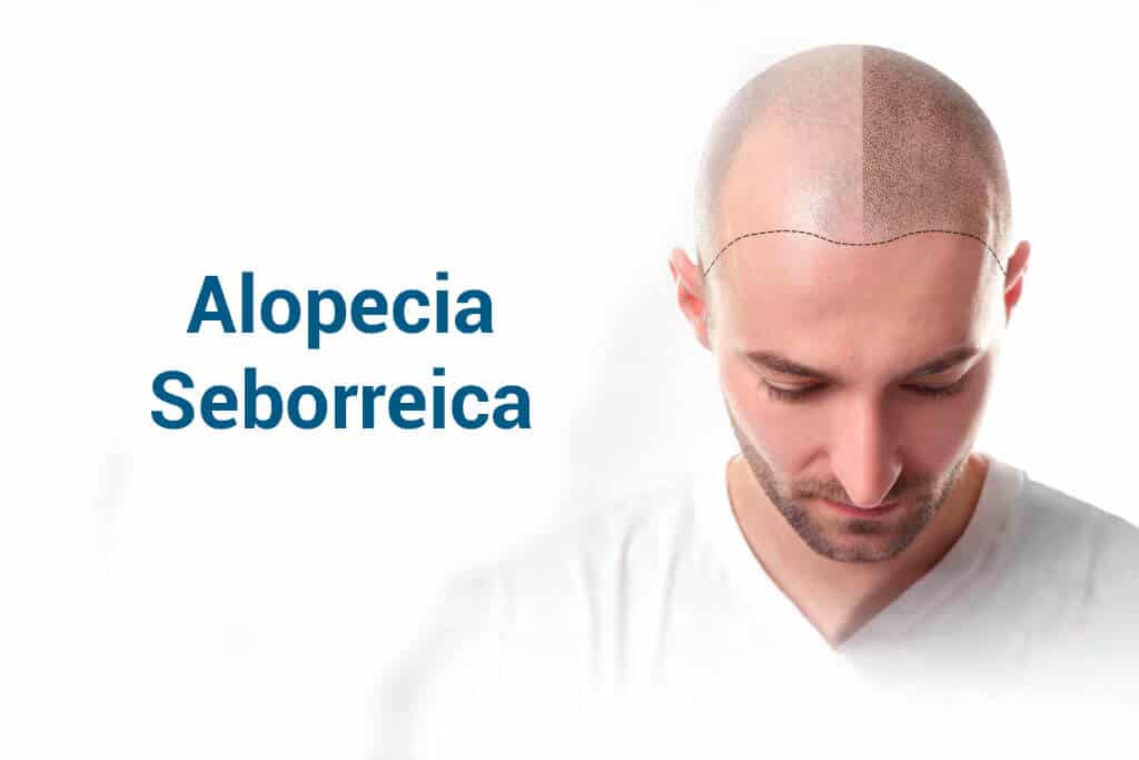 Alopecia suborroidale