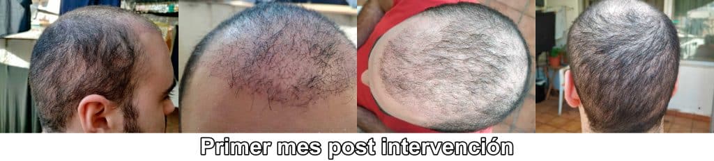 1° mese dopo il trapianto di capelli