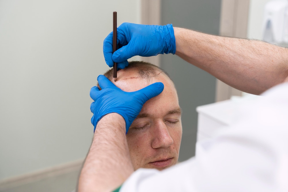 Trapianto di capelli: è una procedura dolorosa?